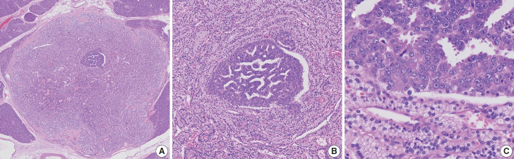 Malignant potential of neuroendocrine microtumor of the pancreas harboring high-grade transformation: lesson learned from a patient with von Hippel-Lindau syndrome.