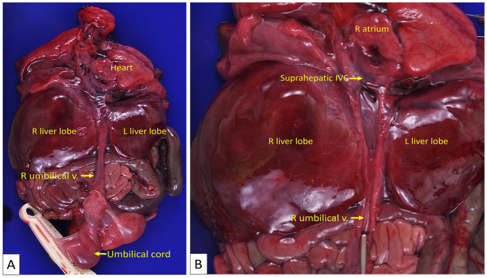 Absence of Ductus Venosus: A Comparison of 2 Distinctive Fetal Autopsy Cases and Embryologic Perspectives.