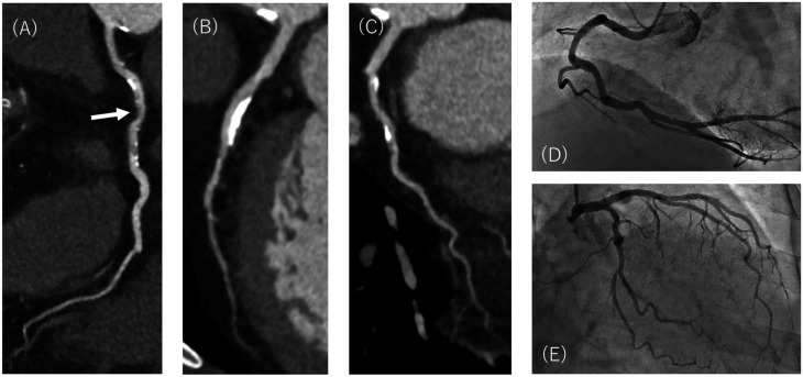 Super-resolution deep learning reconstruction to improve image quality of coronary CT angiography.