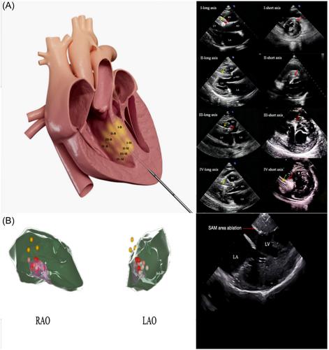 Short time effects of two radiofrequency ablation methods on hypertrophic obstructive cardiomyopathy