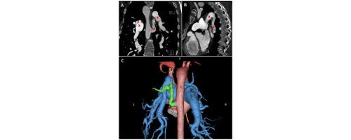 Late Diagnosis of Residual Major Aortopulmonary Collateral in a Patient with Tetralogy of Fallot