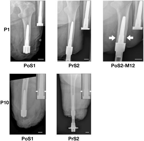 Association between blood markers and the progression of osseointegration in percutaneous prostheses patients—A pilot study