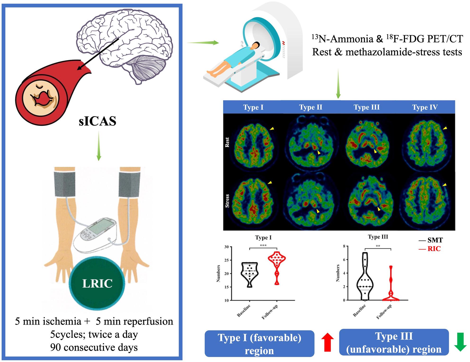 Remote ischemic conditioning improves cerebral hemodynamics in symptomatic intracranial atherosclerosis: A PET/CT-guided randomized controlled study