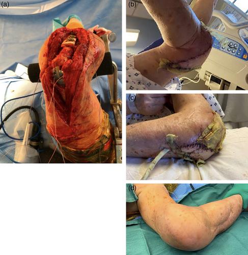 Free flap reconstruction of elbow soft tissue defects: Lessons learned from 15 years of experience