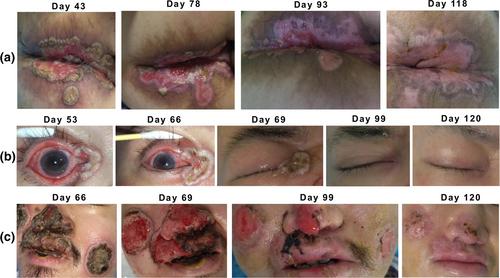 Successful treatment of severe monkeypox case with advanced HIV infection using plasma from smallpox-vaccinated healthy population: A case report