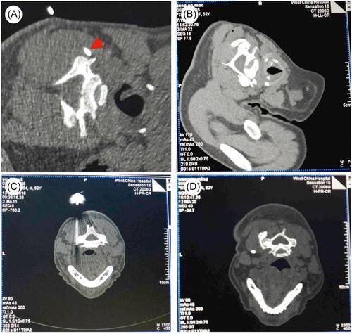 Accuracy and efficacy of ultrasound-guided puncture (vs. computed tomography-guided) in cervical medial branch blocks for cervicogenic pain: A randomized controlled study