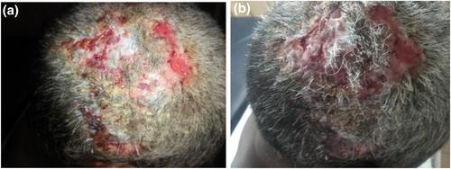 Bullous pemphigoid is a rare autoimmune skin disease that affects the scalp: A case report