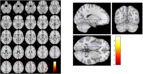 Montreal cognitive assessment in Brazilian adults with sickle cell disease: The burdens of poor sociocultural background