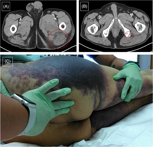 Emicizumab for acquired hemophilia A: Report of two cases and dosing strategies