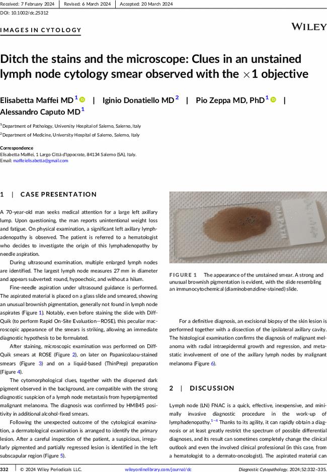 Ditch the stains and the microscope: Clues in an unstained lymph node cytology smear observed with the ×1 objective