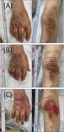 Outpatient superficial partial-thickness burn care of an elderly patient successfully treated with Eppikajutsuto