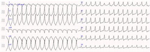 Idiopathic ventricular tachycardia detected after coronavirus disease 2019