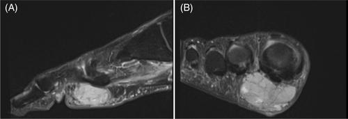 Primary cutaneous NUT carcinoma with BRD4::NUTM1 fusion