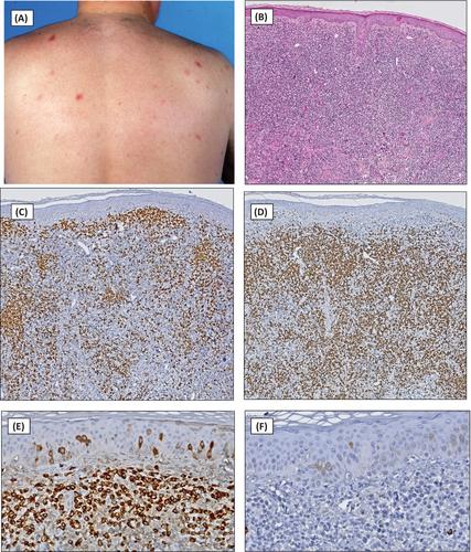 Cutaneous lymphoproliferative disorders: Back to the future