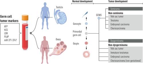 Malignant ovarian and testicular germ cell tumors: Common characteristics but different prognoses