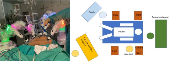 Extraperitoneal robot assisted laparoscopic prostatectomy with Versius system: single centre experience