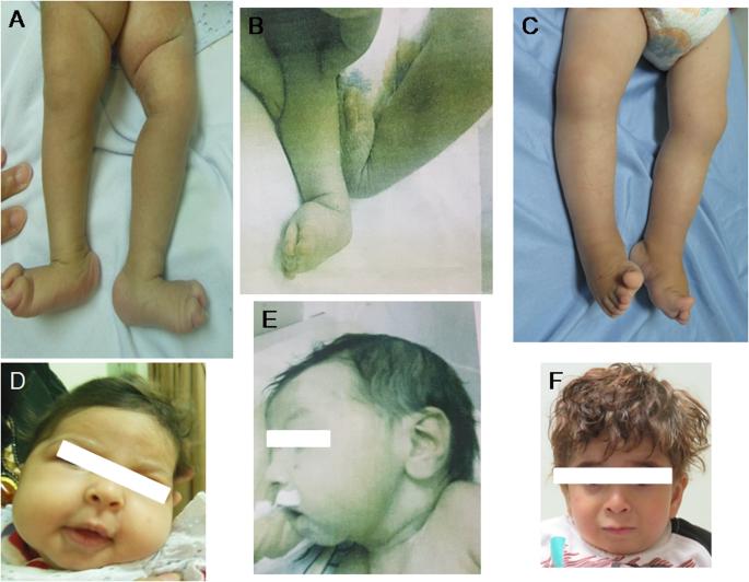 New insights into the clinical and molecular spectrum of the MADD-related neurodevelopmental disorder