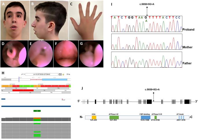 Combined exome and whole transcriptome sequencing identifies a de novo intronic SRCAP variant causing DEHMBA syndrome with severe sleep disorder