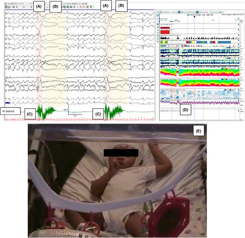 Electroclinical features of myoclonic-tonic and spasm-tonic seizures in childhood