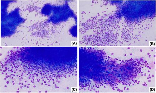 A sub-hepatic nodule in a young female: Chase the case