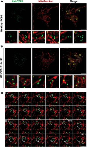 A Novel Fluorogenic Probe Reveals Lipid Droplet Dynamics in ME/CFS Fibroblasts