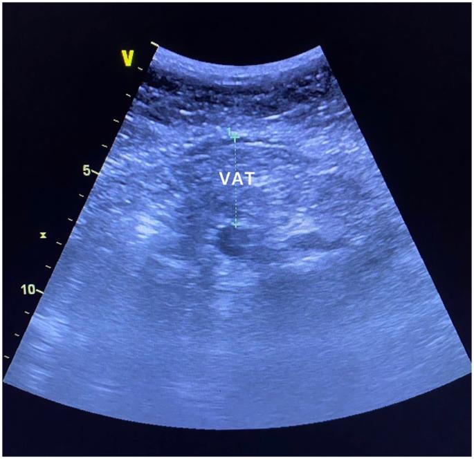 Is phase angle associated with visceral adiposity and cardiometabolic risk in cardiology outpatients?