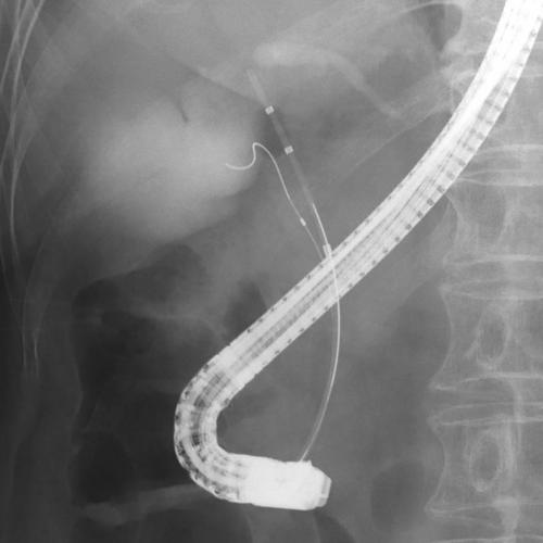 Two-devices-in-one-channel method using a balloon catheter in a case of difficult cannulation into the gallbladder caused by a remarkably steep cystic duct in endoscopic gallbladder stenting