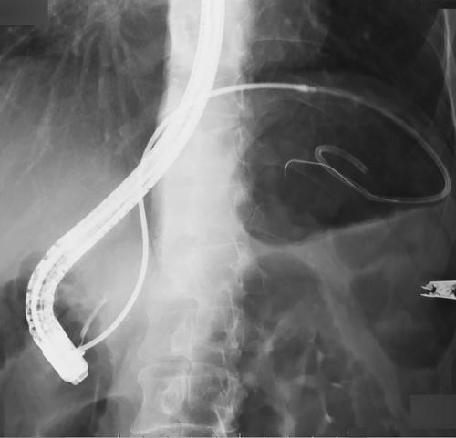 Endoscopic retrieval of the torn pancreatic stent by pushing out through the EUS-PD fistula tract