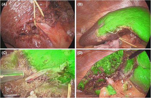 Advantages of laparoscopic segmentectomy of the liver using ICG fluorescent navigation by the negative staining method: A comparison with open procedure