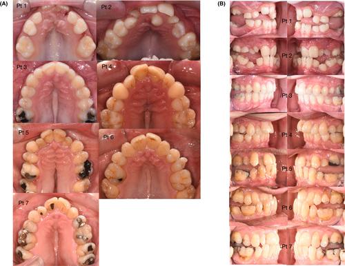 Pycnodysostosis: Characteristics of teeth, mouth and jaws