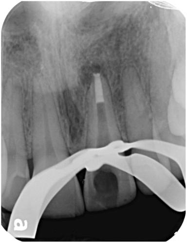 Intraradicular reinforcement of traumatized immature anterior teeth after MTA apexification