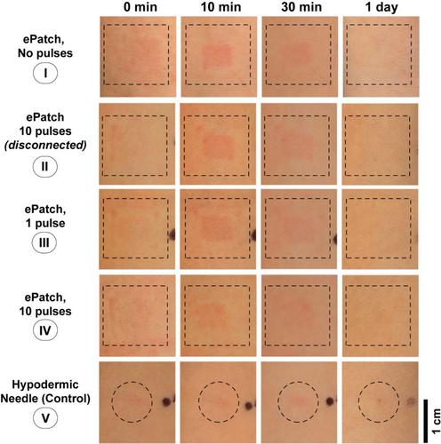 Tolerability of a piezoelectric microneedle electroporator in human subjects