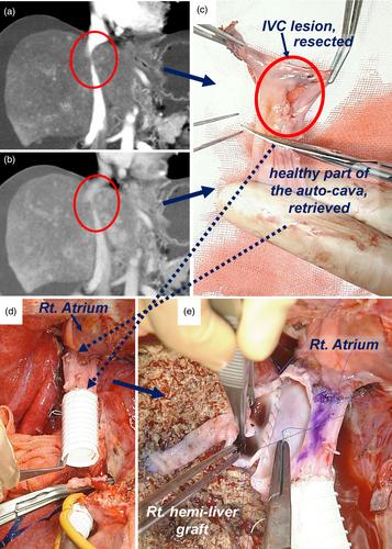 Venous outflow reconstruction in living-donor liver transplantation for Budd–Chiari syndrome involving vena cava