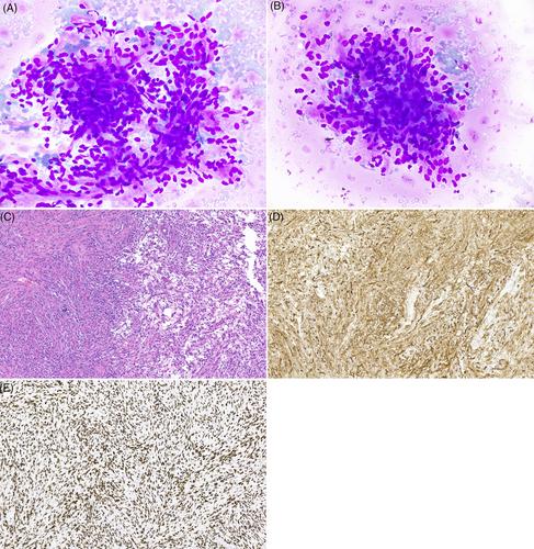 Solitary fibrous tumor of deep parotid gland preoperatively classified as salivary gland neoplasm of uncertain malignant potential by the Milan system for reporting salivary gland cytopathology: A common diagnosis for a rare entity