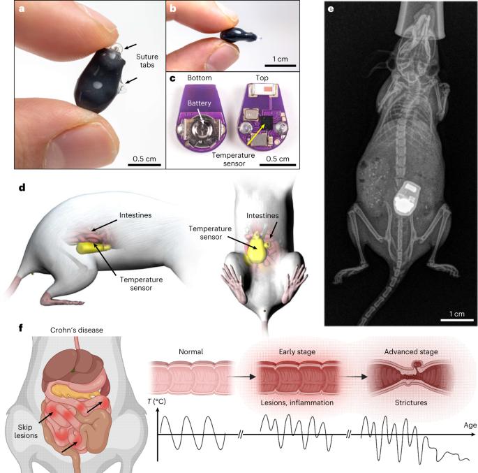 Miniaturized implantable temperature sensors for the long-term monitoring of chronic intestinal inflammation