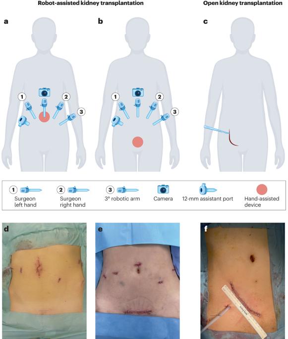 Robotic kidney transplantation