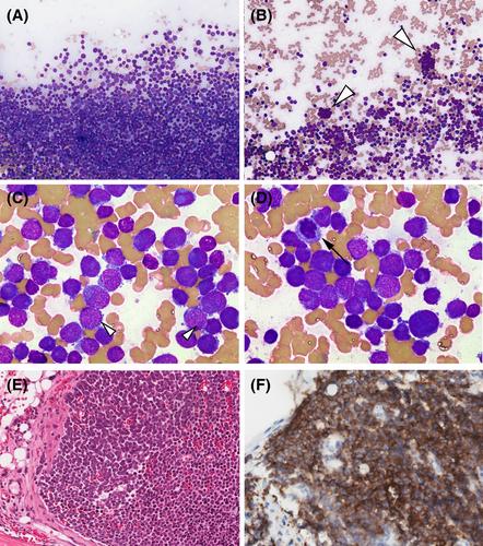 Merkel cell carcinoma mimicking acute leukemia