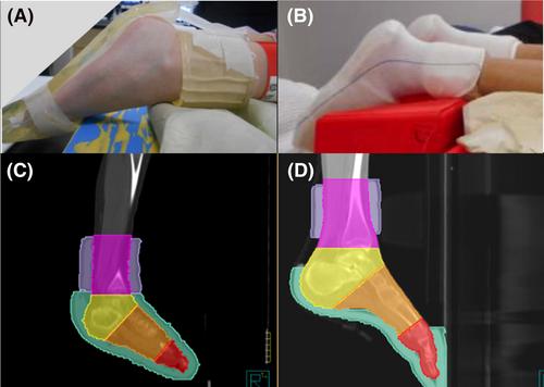 An evaluation of ankle and foot bolus in paediatric modulated arc total body irradiation (MATBI)