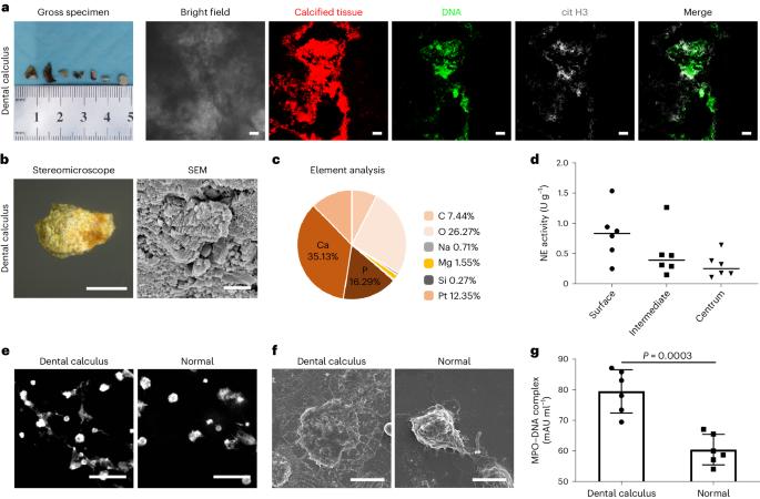 Bacteria-mediated resistance of neutrophil extracellular traps to enzymatic degradation drives the formation of dental calculi