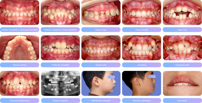 Expert consensus on pediatric orthodontic therapies of malocclusions in children