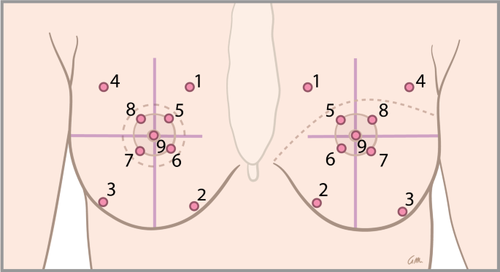 The influence of a previous implant-based breast reconstruction on postoperative sensation of the deep inferior epigastric artery perforator flap