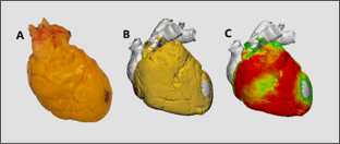 Ventricular Epicardial Adipose Distribution on Human Hearts: 3-Dimensional Reconstructions and Quantitative Assessments