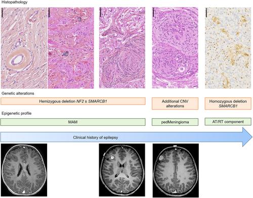 A comprehensive histomolecular characterization of meningioangiomatosis: Further evidence for a precursor neoplastic lesion