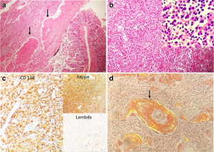 Amyloid Secreting Jejunal Plasmacytoma