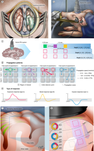 Depth-Specific Hypoxic Responses to Spreading Depolarizations in Gyrencephalic Swine Cortex Unveiled by Photoacoustic Imaging