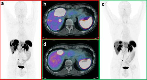 Radionuclide Theranostics in Neuroendocrine Neoplasms: An Update