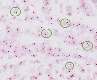 Utility of human epidermal growth factor 2 heterogeneity as a prognostic factor in triple-negative breast cancer