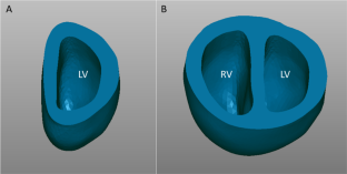 Biventricular finite element modeling of the fetal heart in health and during critical aortic stenosis