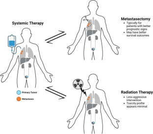 Management of Oligometastatic and Locally Recurrent Urothelial Carcinoma