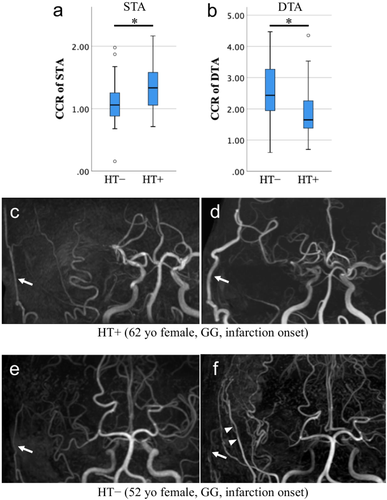 Association of Genetic Variants with Postoperative Donor Artery Development in Moyamoya Disease: RNF213 and Other Moyamoya Angiopathy-Related Gene Analysis